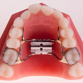 Maxillary expanders