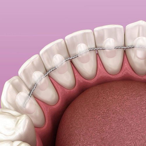  Fixed Retainer or Bonded Lingual Wire