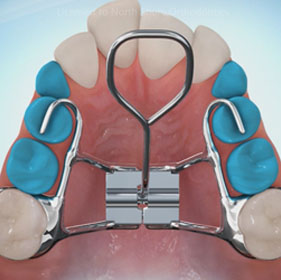 Rapid Maxillary Expander