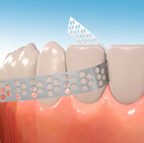 Interproximal Reduction