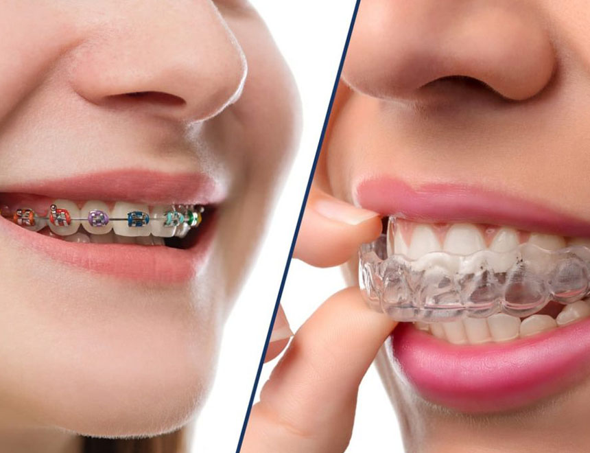 Is Invisalign® Cheaper Than Braces in Australia? What You Need to Know Is Invisalign® Cheaper Than Braces in Australia? What You Need to Know