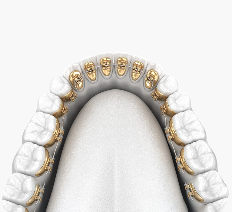  How do lingual braces work?