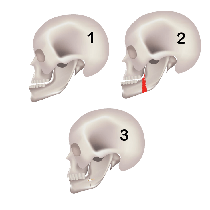  What does jaw surgery involve?