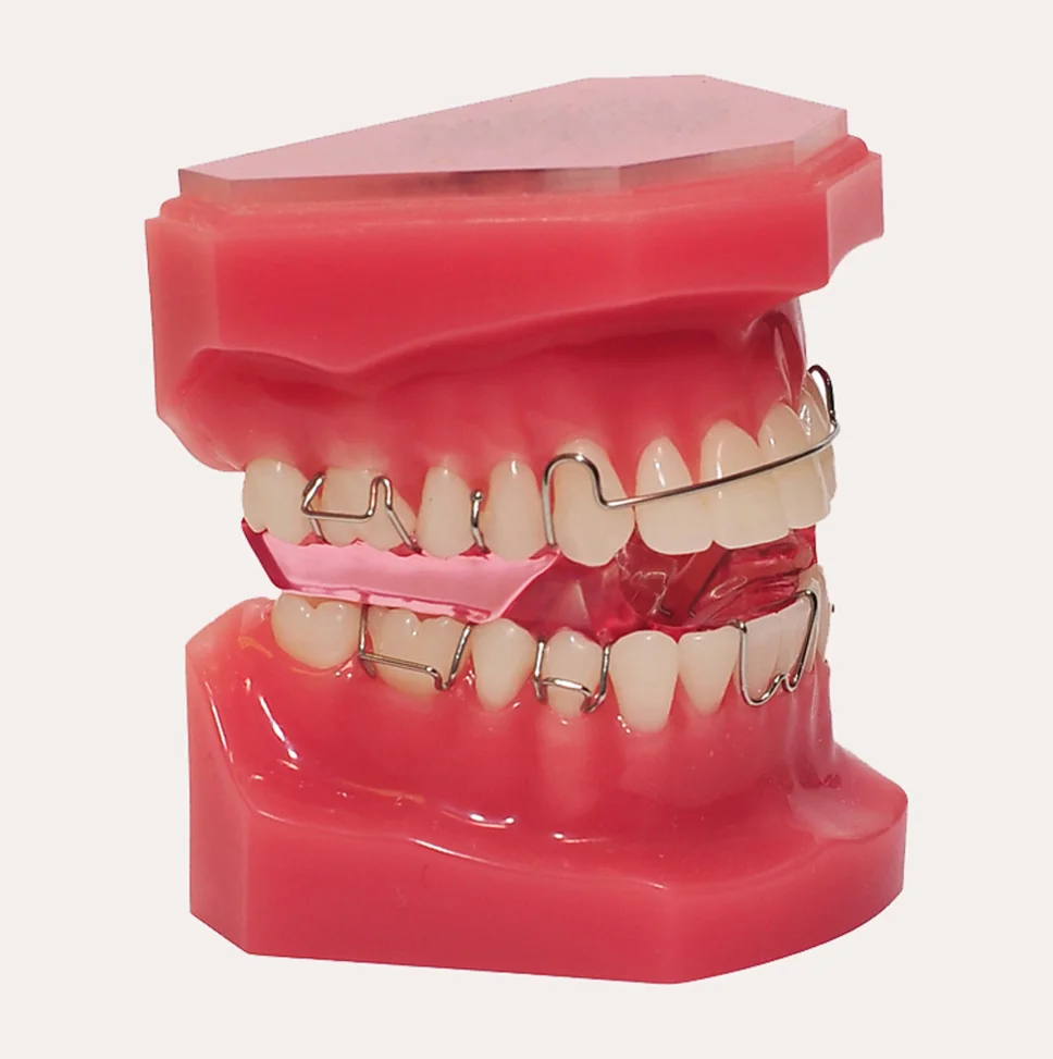 What are twin block braces? A Melbourne guide from Angle House Orthodontics